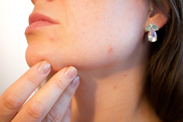 mujer mostrando el acné de su cara que quiere eliminar